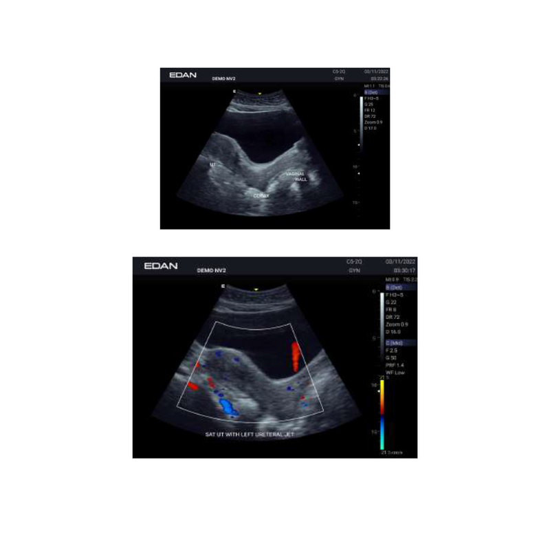 EDAN Acclarix AX2 Compact Ultrasound System (One Transducer Port)