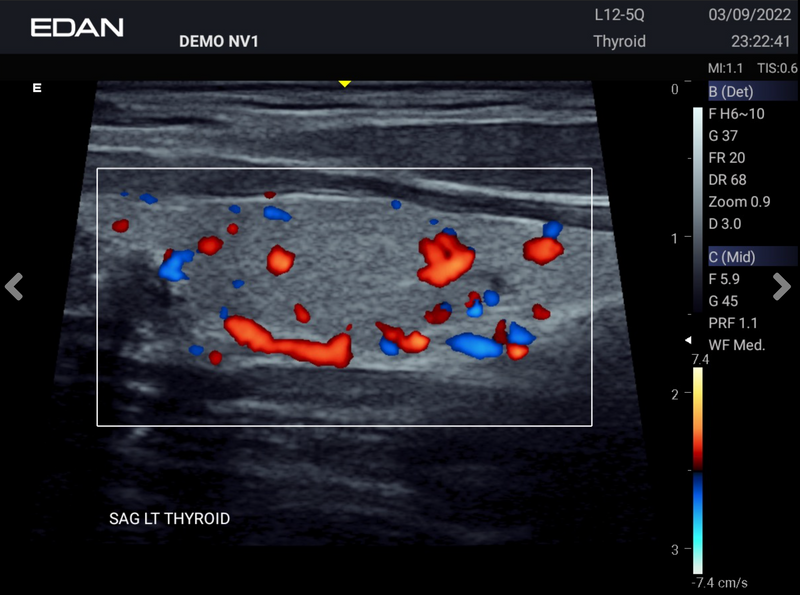 EDAN Acclarix AX3 Compact Ultrasound System (Two Transducer Ports)