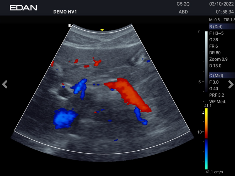 EDAN Acclarix AX3 Compact Ultrasound System (Two Transducer Ports)