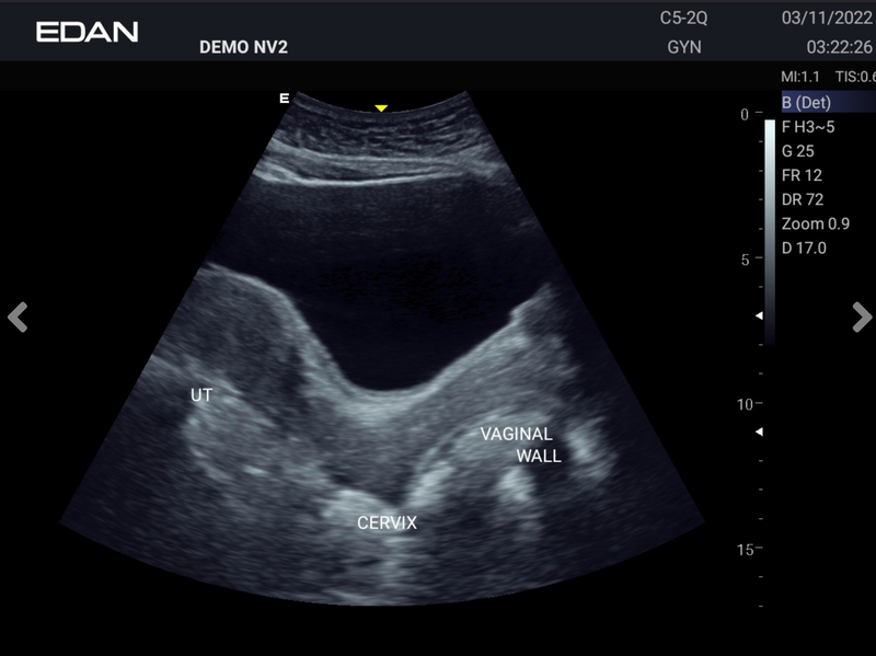 EDAN Acclarix AX3 Compact Ultrasound System (Two Transducer Ports)