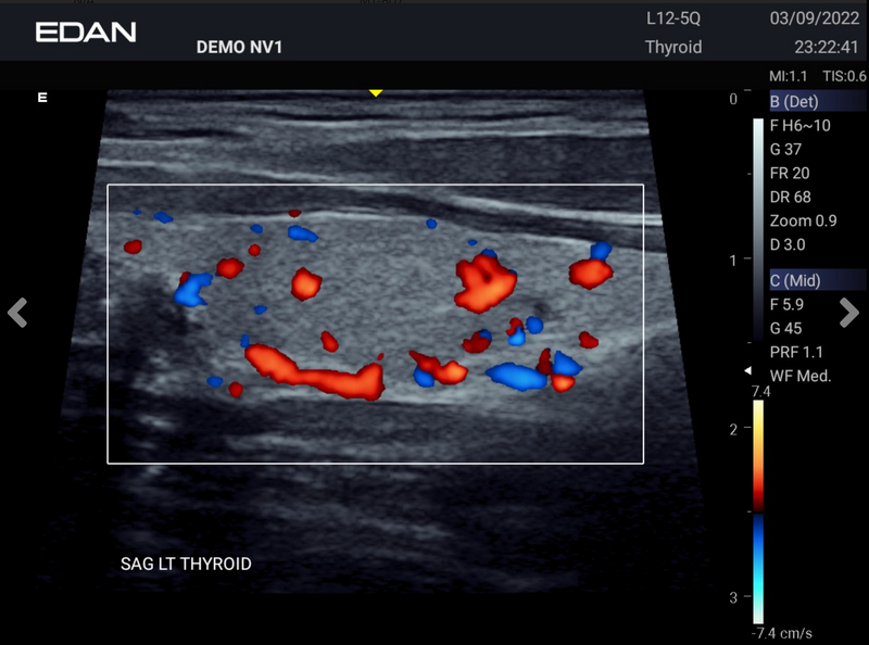 EDAN Acclarix AX2 Compact Ultrasound System (One Transducer Port)