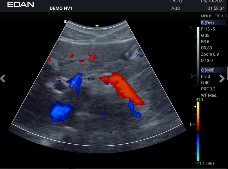 EDAN Acclarix AX2 Compact Ultrasound System (One Transducer Port)