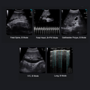 Chison SonoEye P5 HandHeld Ultrasound Convex