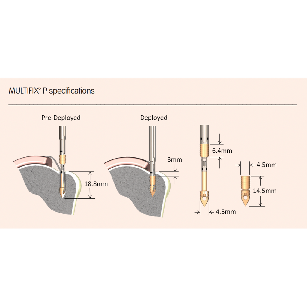 MULTIFIX™ System PEEK Knotless Fixation Implants 4.5MM Implant - Ideal